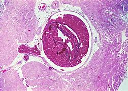 Image result for Thrombosis Histology