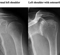 Image result for Arcritic Shoulder