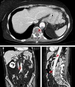 Image result for What Is a Thrombus