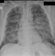 Image result for Acute Pulmonary Oedema Positioning