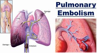 Image result for Pulmonary Embolism Post-Mortem Changes