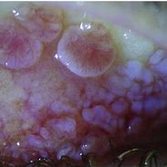 Image result for Tarsal Conjunctiva Papillae