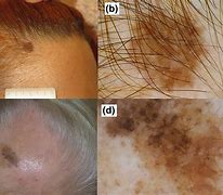 Image result for Melanoma Head