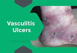 Image result for Vasculitis Leg Ulcers