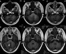 Image result for Cerebellar Vermis MRI