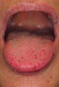 Image result for Blood Spots Under Tongue