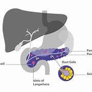 Image result for Pancreatic Adenocarcinoma