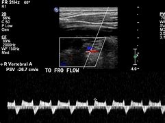 Image result for Retrocaval Artery