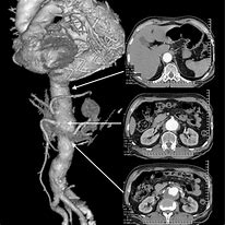 Image result for Angio CT Scan