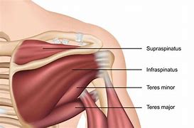 Image result for Supraspinatus and Infraspinatus Tendinopathy