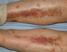 Image result for Skin Darkening Legs