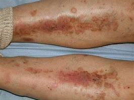 Image result for Thickened Skin On Lower Legs