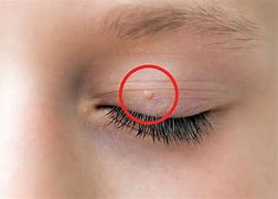 Image result for Flat Warts On Eyelids