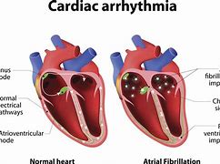 Image result for Vagal AFib Symptoms