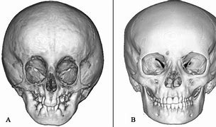 Image result for Craniofacial Surgery