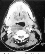 Image result for Retrocaval Cyst