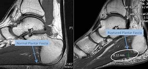 Image result for Plantar Fascia Rupture