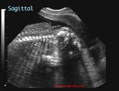 Image result for Anencephaly Ultrasound