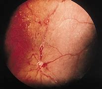 Image result for Damaged Retina