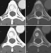 Image result for Bone Metastases