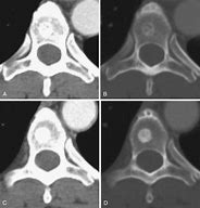 Image result for Sclerosis Bone Metastases X-ray