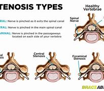 Image result for Stenosis