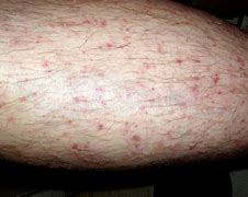 Image result for 10 Common Skin Rashes On Legs