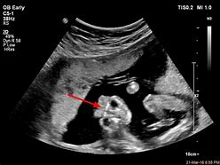 Image result for Anencephaly Ultrasound