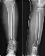 Image result for Open Pilon Fracture