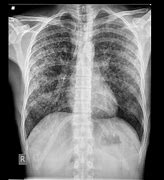 Image result for Miliary Tuberculosis Chest X-ray