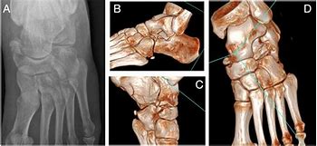 Image result for Chopart Fracture