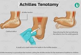 Image result for Heel Cord Tenotomy