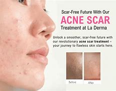 Image result for What Helps with Acne Scars