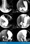 Image result for Stomach in X-ray