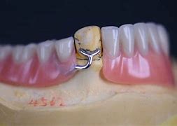 Image result for Partial Denture Clasps