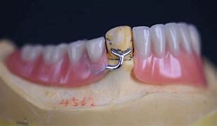 Image result for partial denture clasps materials