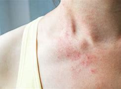 Image result for Soap Skin Rash