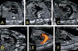 Image result for LVOT Rvot Ultrasound