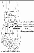 Image result for Lisfranc Orif