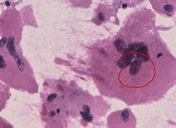 Image result for Adrenal Cytology