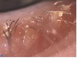 Image result for Demodex Mite Infestation