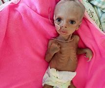 Image result for Starving Ethiopian Child