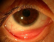 Image result for Tarsal Conjunctiva Papillae