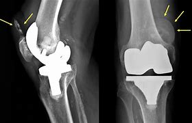 Image result for Left Knee Arthroplasty