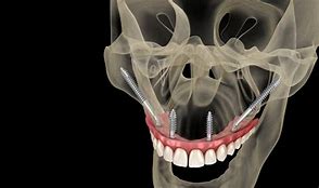 Image result for Zygomatic Surgery