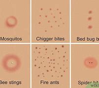 Image result for Different Bug Bites