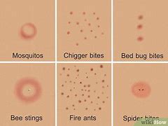 Image result for Bug Bites and Stings