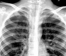 Image result for Asthma Chest X-Ray