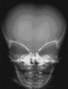 Image result for Achondroplasia X-ray