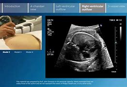 Image result for Rvot and LVOT Fetal Ultrasound Images Colour